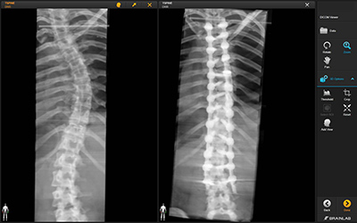 Scoliosis X-ray 1
