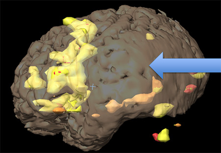 Functional MRI image showing brain swelling that indicates the presence of a tumor below