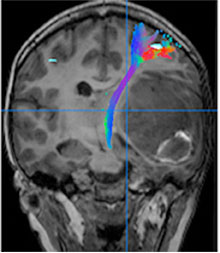 Advanced tractography for metastatic brain tumor