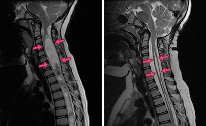 These MRI scans show a Chiari patient's syrinx (left, before surgery), and the reduction in the size of the syrinx after surgery (right, arrows). 