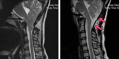 These MRI scans show a patient before (left) and after (right) surgery for Chiari malformation. 