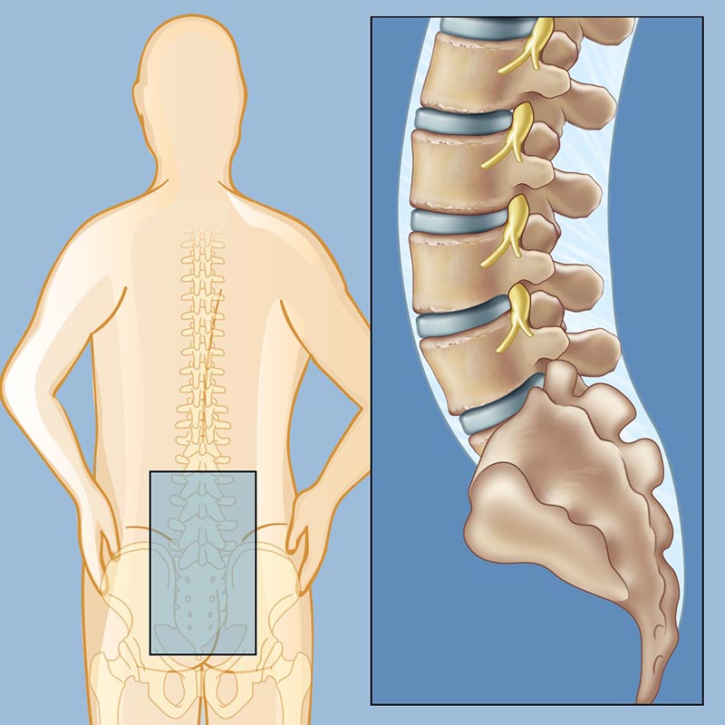 Lower Back Pain  Neurological Surgery