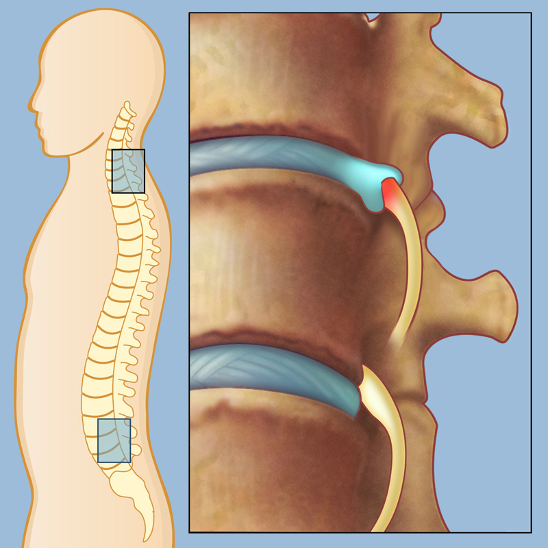 Causes of Neck Pain and Treatment Options: NY Neurology Associates:  Neurologists