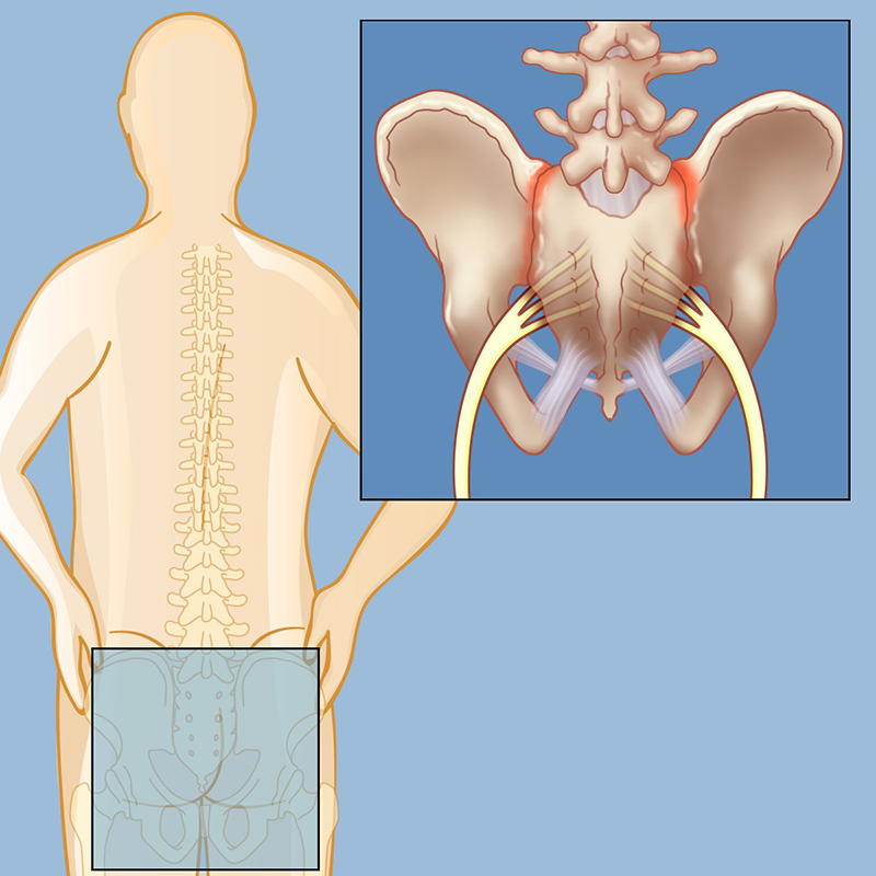 Sacroiliac (SI) Joint Pain: Causes, Symptoms, Treatment