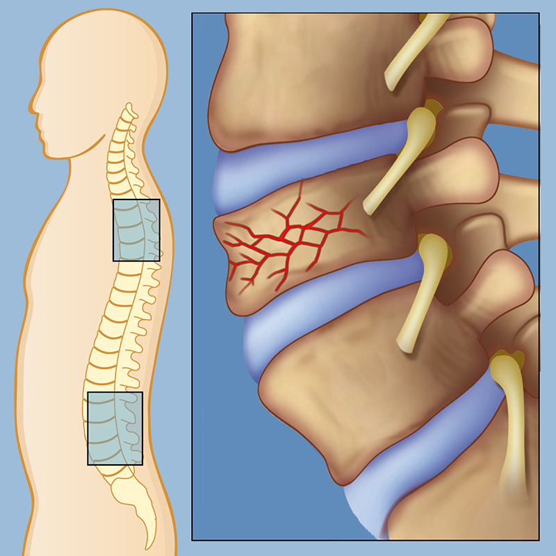 Vertebral Body Fractures and Vertebral Compression Fractures