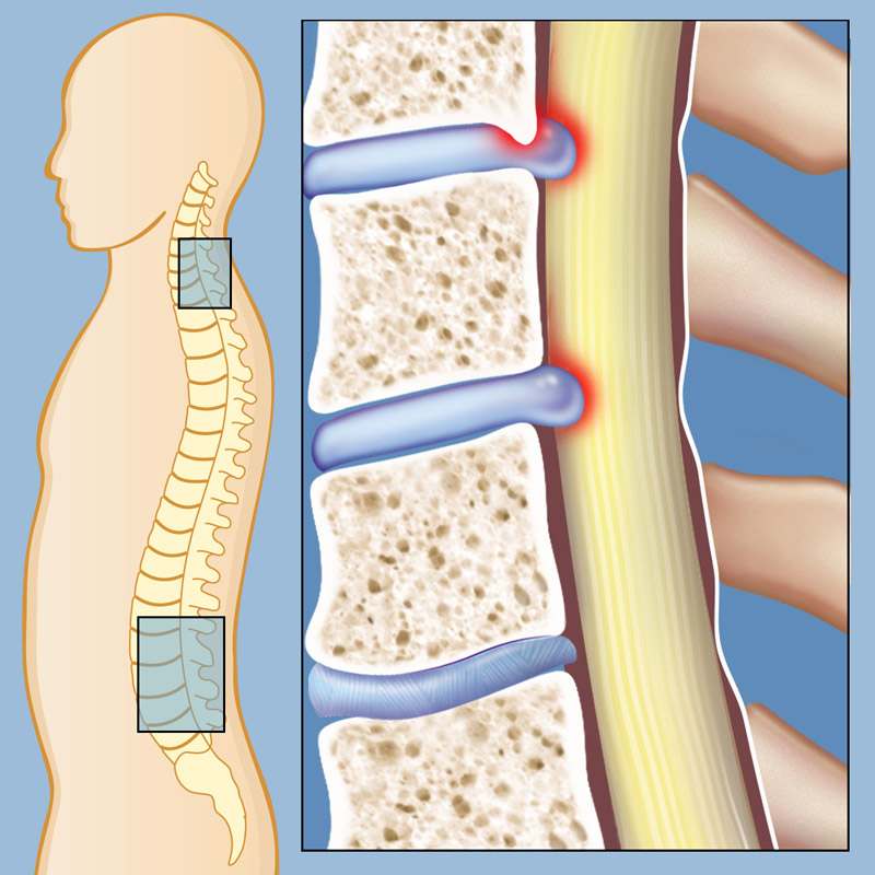 Lumbar Stenosis: Causes, Symptoms and Treatment Options for