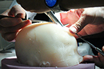 Open and Endoscopic Surgery for Craniosynostosis at Weill Cornell Medicine