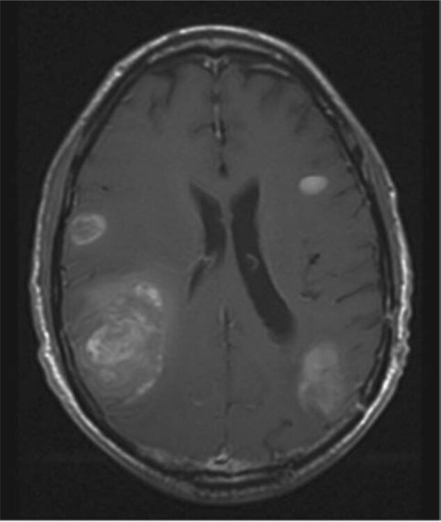 Brain Metastasis Tumor