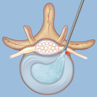 The goal of microdiscectomy is to remove the bulge from the herniated portion of the disc and to relieve pressure on the affected nerve. 