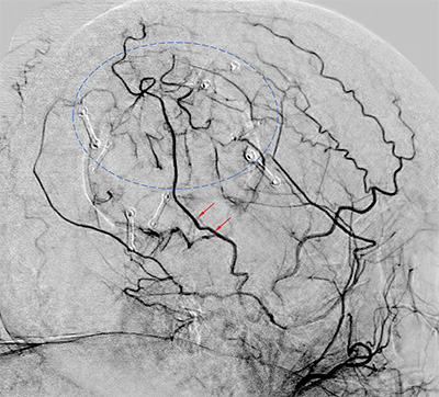 Cerebral angiography 6 months after surgery demonstrates revascularization via the STA graft