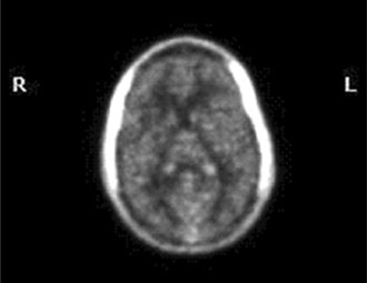 PET scan of normal patient - no inflammation