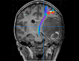 Brain mets tractography