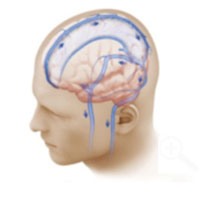 In a normal brain, there is unobstructed blood flow from the brain towards the neck (blue arrows).