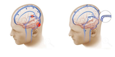 The illustration at left shows bilateral venous sinus narrowing (red circles), which compromises blood flow from the brain to the neck, contributing to intracranial hypertension. In the illustration at right, the narrowing has been treated with placement of a stent. As a result the blood flow from the brain to the neck is now restored (blue arrows), relieving the increased intracranial pressure and the symptoms of pseudotumor cerebri.
