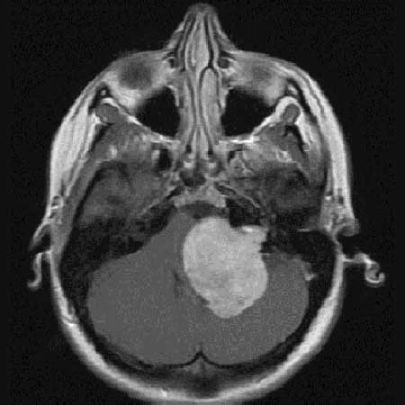 Acoustic Neuroma MRI Scan