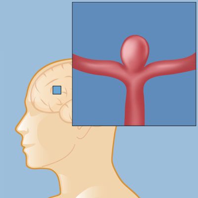 berry aneurysm