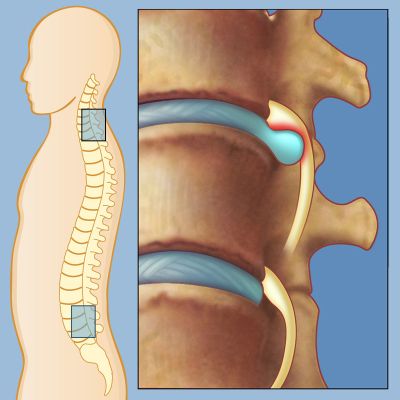 herniated disc