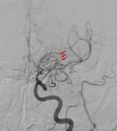 Angiogram of Moyamoya disease