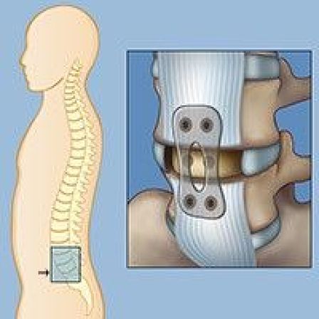 ALIF, TLIF, and LLIF for Lower Back Pain | Neurological Surgery
