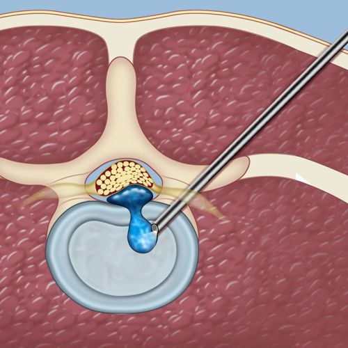 Spinal Endoscopy at Weill Cornell Medicine