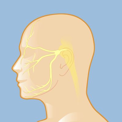 trigeminal neuralgia