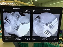 Dr. Scott Zuckerman uses intraoperative imaging during trauma surgery in Tanzania