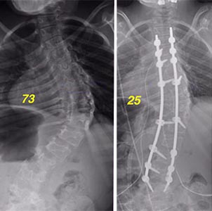 Bethany's spine scans, before and after