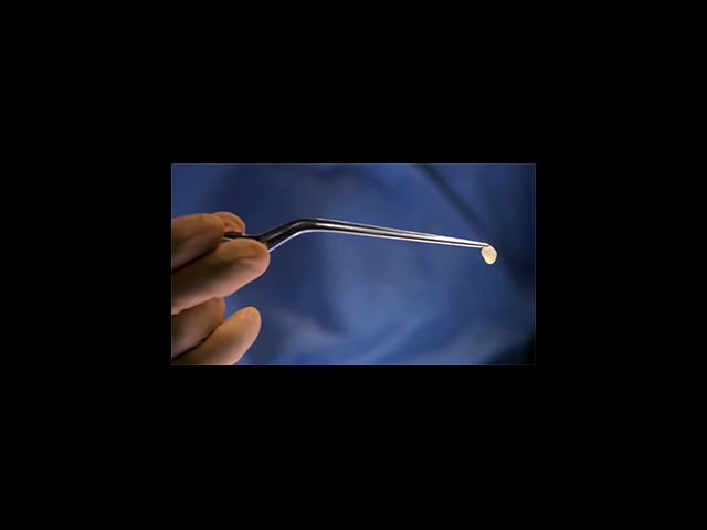 colloid cyst 