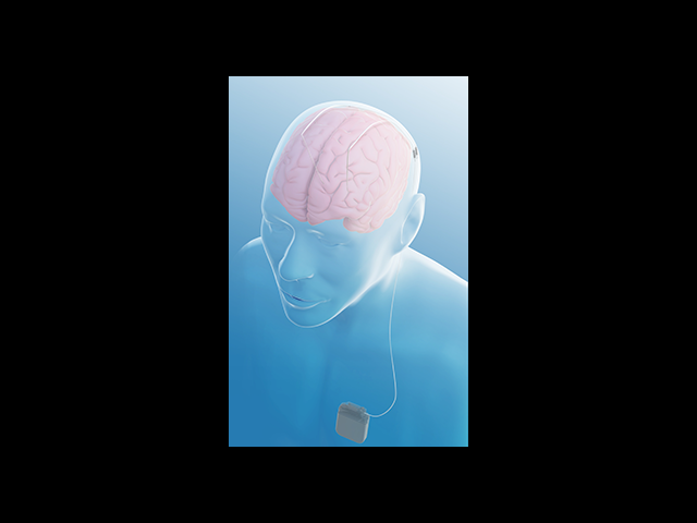 Deep Brain Stimulation Now Available for Epilepsy - Medtronic bilateral activa