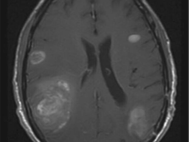 Brain Metastasis Tumor