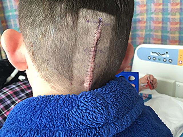 Chiari surgical incision, two days post-op
