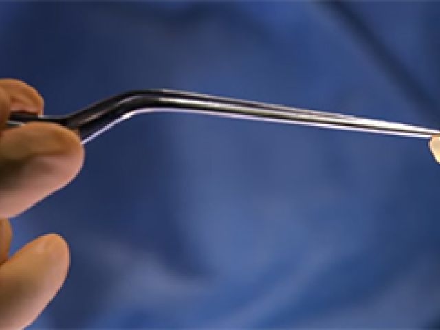 colloid cyst 