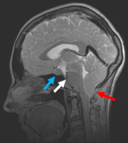 Spinal CSF leaks lead to intracranial hypotension (low pressure). This MRI brain image shows typical