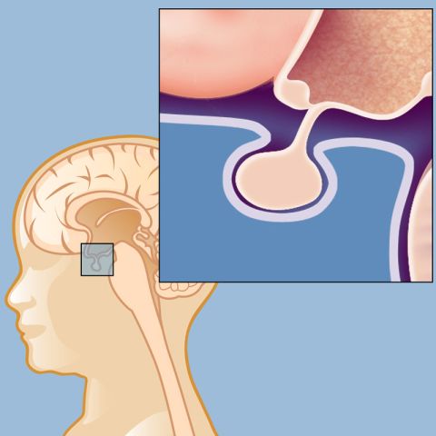 Craniopharyngiomas usually develop near the pituitary gland
