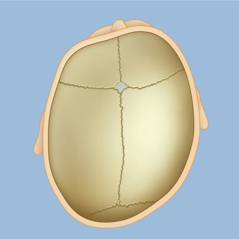 Deformational plagiocephaly