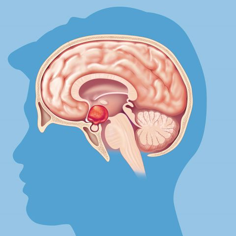 Germ cell tumors sometimes form near the pituitary gland