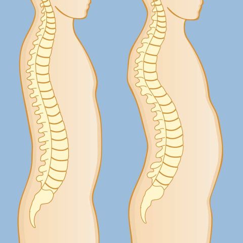 Healthy spine (left) versus kyphosis (right)