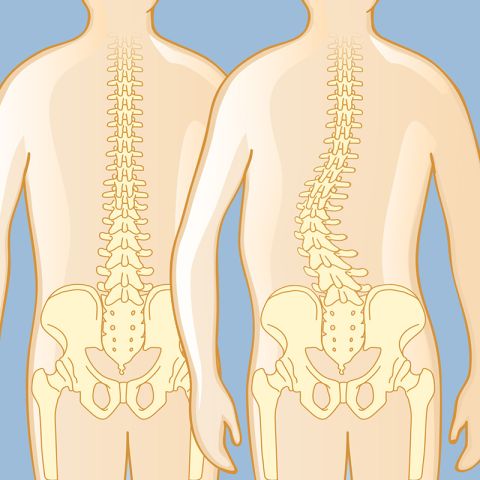 Scoliosis (Adult)
