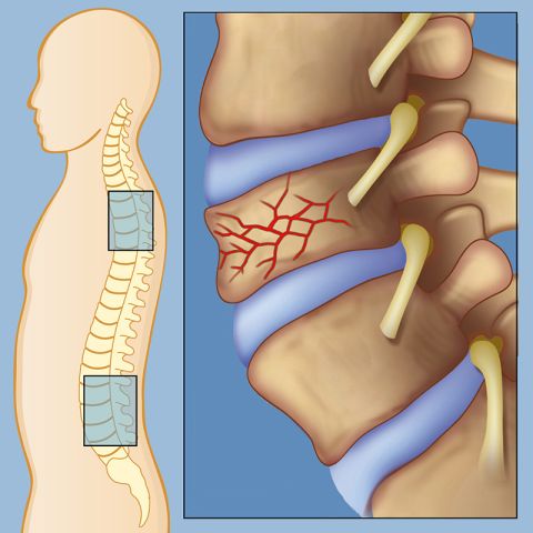 Spinal compression fracture