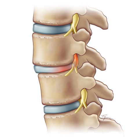 In a patient with spondylolisthesis, the disc between vertebrae may be fine, but the bony vertebrae themselves may have slipped out of position, putting pressure on a nerve. Spondylolisthesis