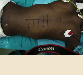 This patient had suffered severe back trauma that required a laminectomy