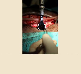 Procedure done minimally invasively through tubes. 