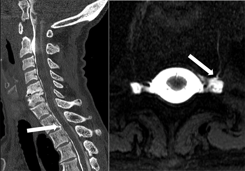 Imaging a spinal CSF leak