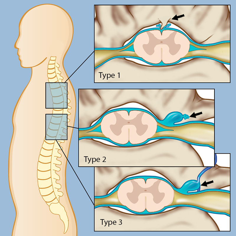 Three types of spinal csf leak