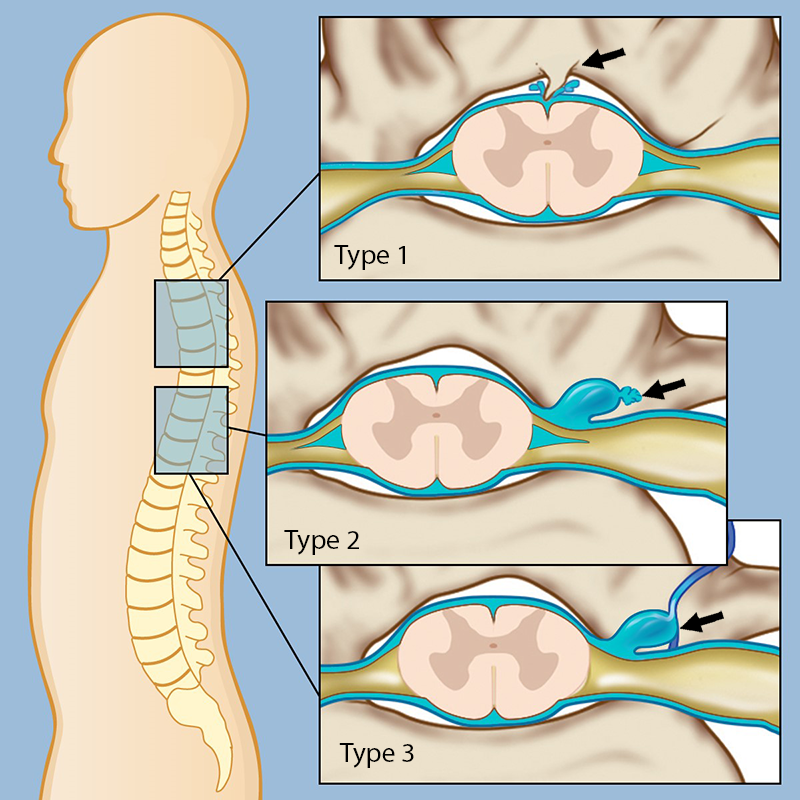 CSF Leak - SinusHealth  CSF Leak Symptoms and Causes