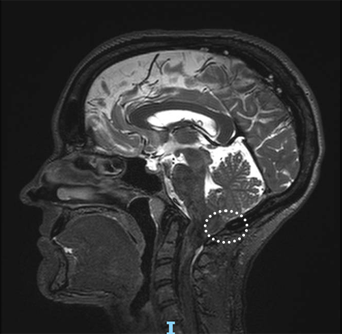 Abby's MRI scan showed the area of malformation (circled) that was causing her headaches