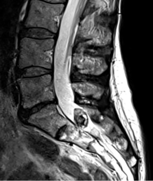 A pre-operative MRI scan revealed that Orna had a tumor on her spine, but it could not provide more precise information about it.