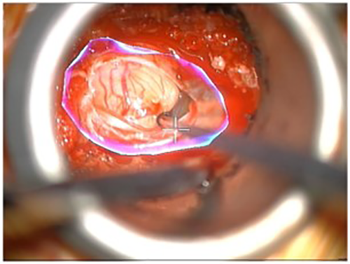 Augmented reality allows a neurosurgeon to visualize the margins of a tumor even when they are not visible to the eye. In this case the white area at center is the visible tumor; the AR outline shows how much larger the tumor is.