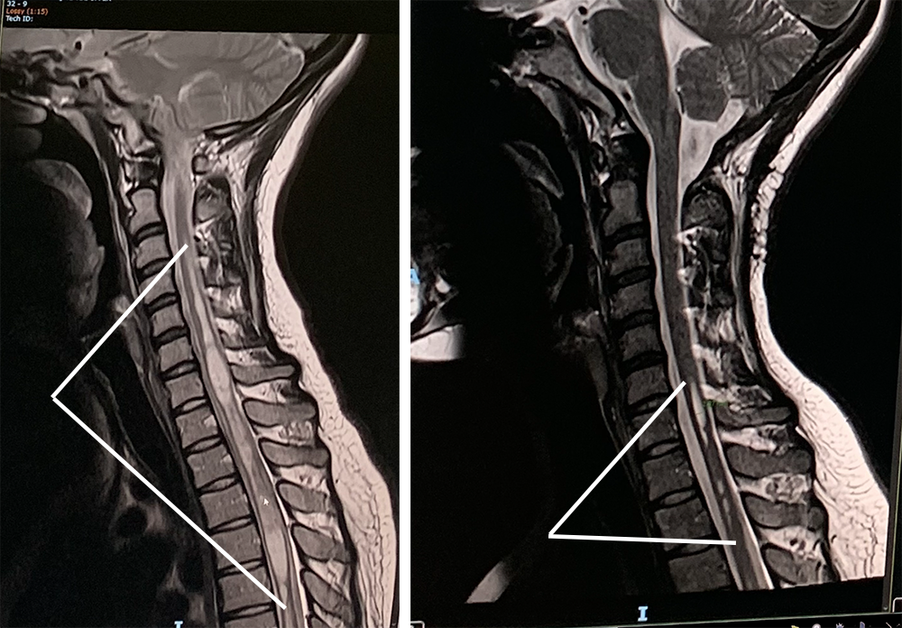 Much of June’s pain was caused by syrinx in her spinal column. Her before-and-after scans show the dramatic reduction in both its length and total volume.