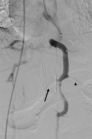 Embolization of a CSF leak with Onyx